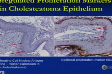 Aula do 47º | Dr. Dennis Poe | Minimally Invasive Endoscopic Approach to Cholesteatoma